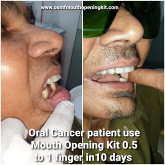 oral cancer Oral Sub Mucous Fibrosis (OSMF) mouth opening treatment in Gujarat